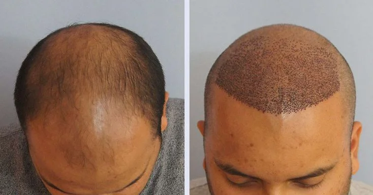 Hiten Tejwani Hair Transplant result